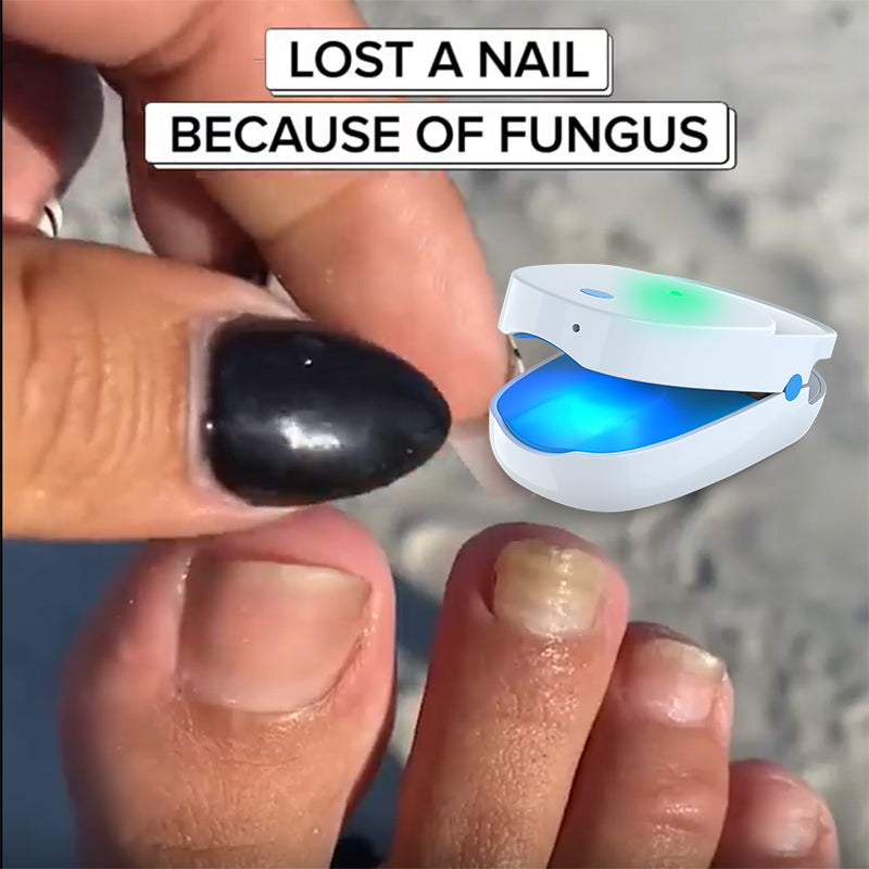 Embrace a Healthy Life Free from Nail Fungus Concerns