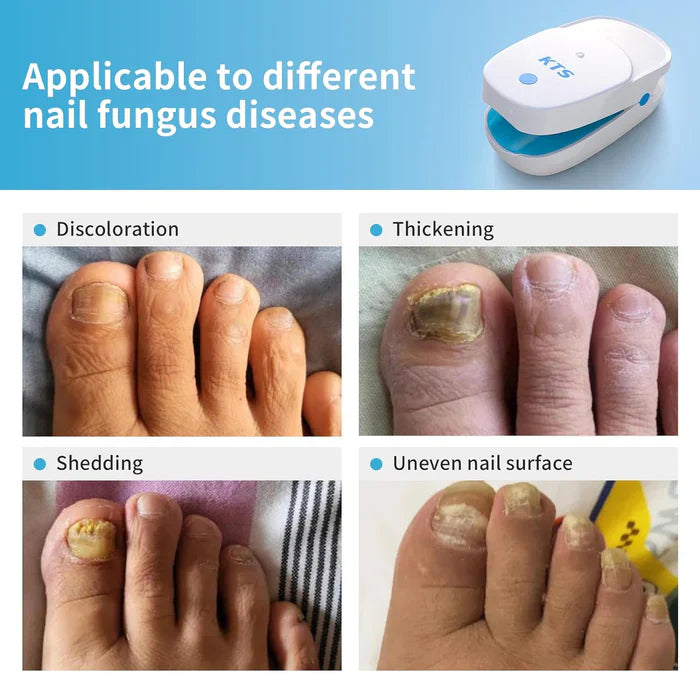 KTS® Nail Fungus Laser Treatment Device