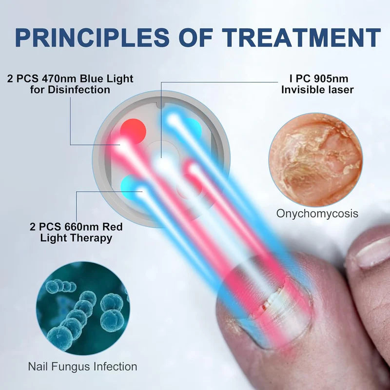 KTS® Nail Fungus Laser Therapy Device