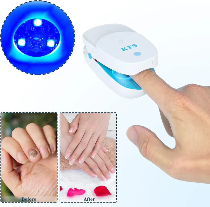 KTS® Nail Fungus Cleaning Device - Onychomycosis