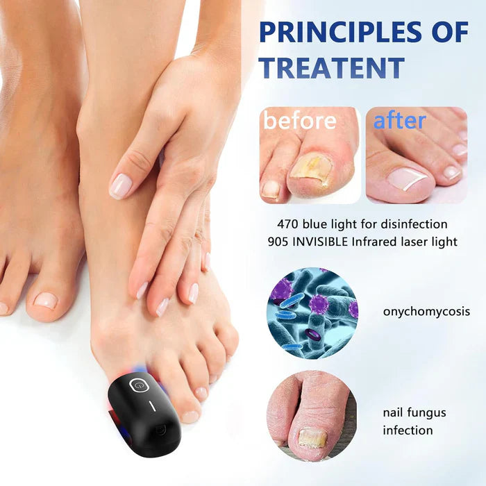 KTS® Nail Fungus Cleaning Device for Onychomycosis