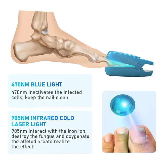 KTS® New Onychomycosis Laser Treatment Device