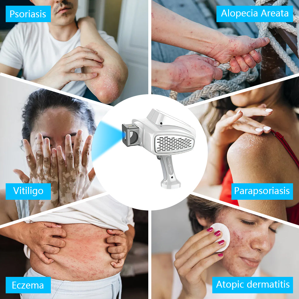 UVB Vitiligo/Psoriasis Light Therapy Device for Home